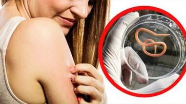 Un'eruzione cutanea sul corpo è un segno di infezione da elminti
